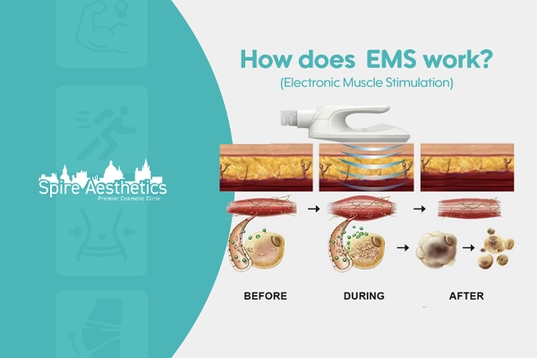 EMS treatment for post pregnancy weight loss treatment Wigan