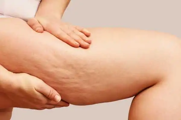 Image of woman showing leg with cellulite Wigan