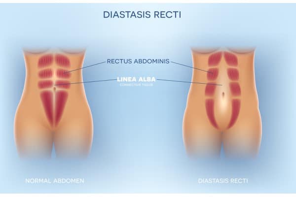 What Non-Surgical Options Are Available for Diastasis Recti Wigan?