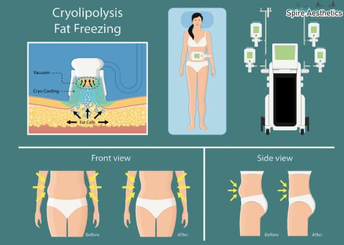 Image of diet and fat freezing combined for best results for Spire Aesthetics Wigan