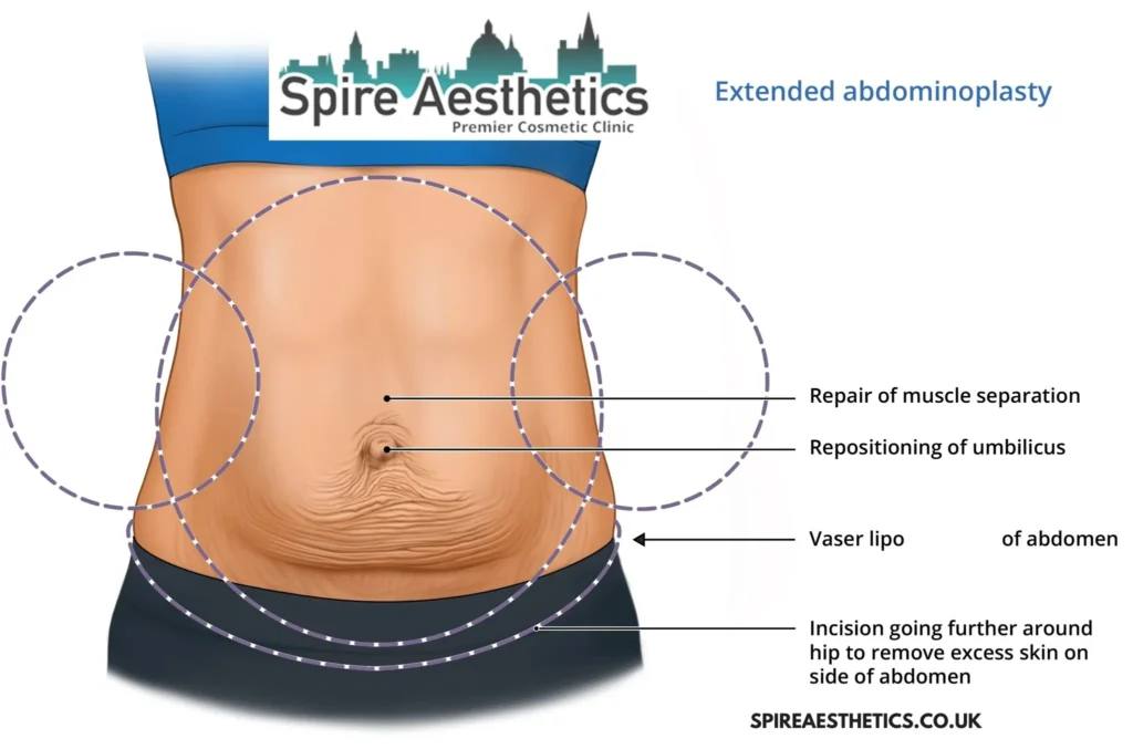 Understanding Loose Skin After Gastric Band Wigan Surgery and HIFU Treatment