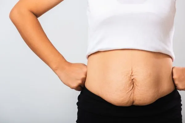 Image of a woman's stomach after weight loss with sagging skin following a gastric band Wigan