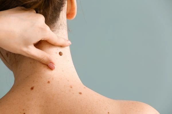 skin blemish removal Wigan treatment