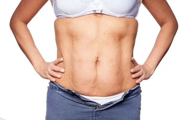 sagging skin on woman's stomach after weight loss injections Wigan