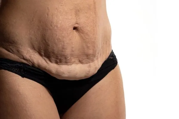 Image of womans stomach after weight loss injections Wigan showing saggy skin