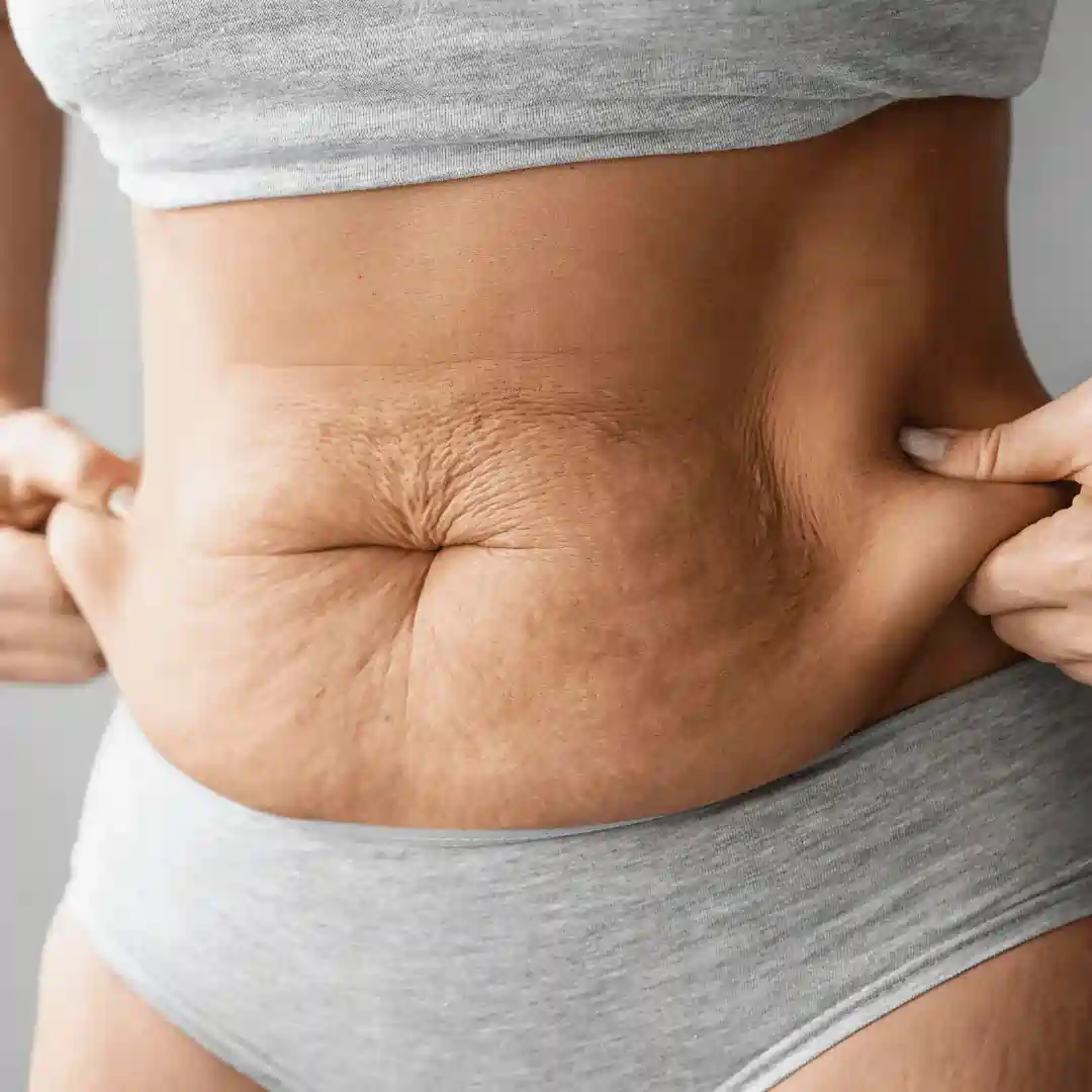 Is It Normal to Have Loose Skin After Pregnancy Wigan?