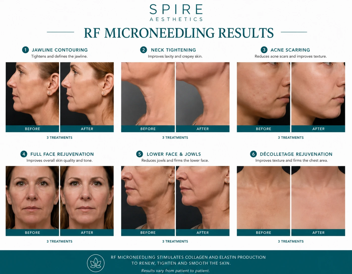 RF Microneedling Skin tightening Wigan results