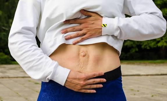 When Could Diastasis Recti Be the Missing Piece of the Puzzle Wigan?