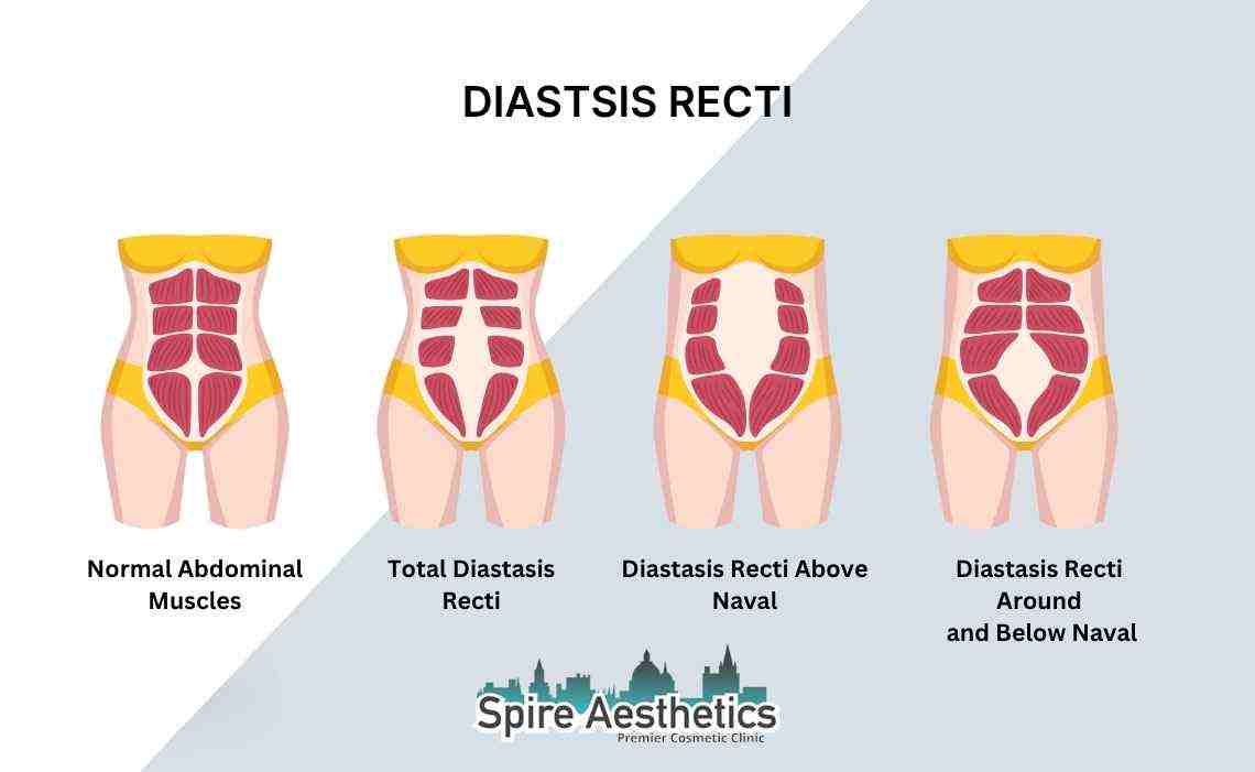 Is Non-Surgical Diastasis Recti Treatment Right for You? Common Concerns Answered Wigan
